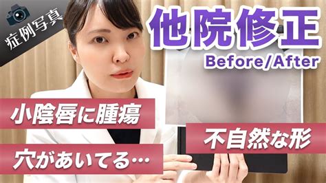 まんこ 整形|女性器形成（小陰唇縮小）の美容整形 